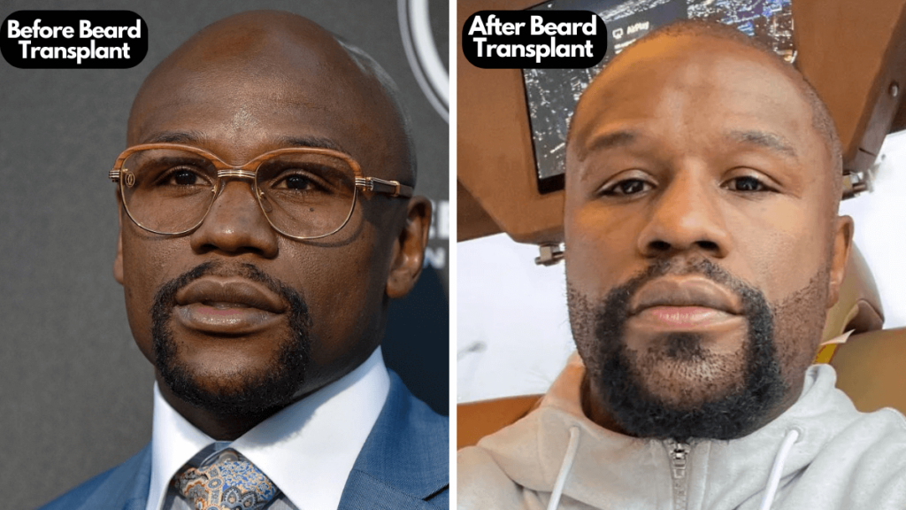 Mayweather beard transplant (before and after)